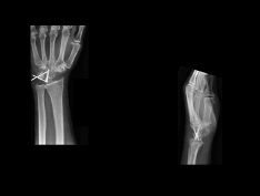 Wrist X-ray